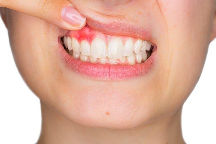 Tooth decay 2