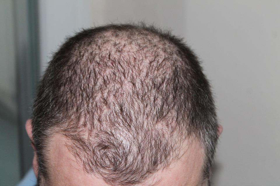 Baldness