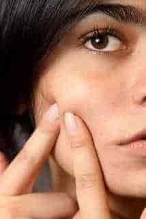 get rid of acne