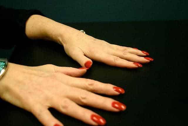 10 home remedies for arhtritis