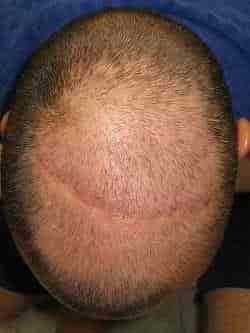 Hair Loss-causes and home remedies