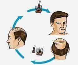 FUT Hair Transplant Procedure