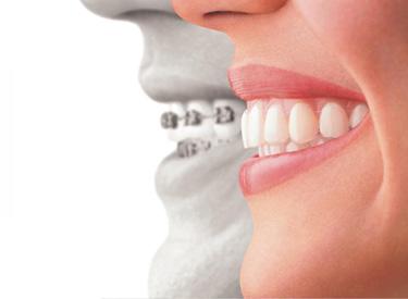 6 Top Reasons Why Invisible Braces Are So Popular